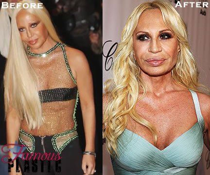 donatella versace before and after plastic surgery. donatella versace before