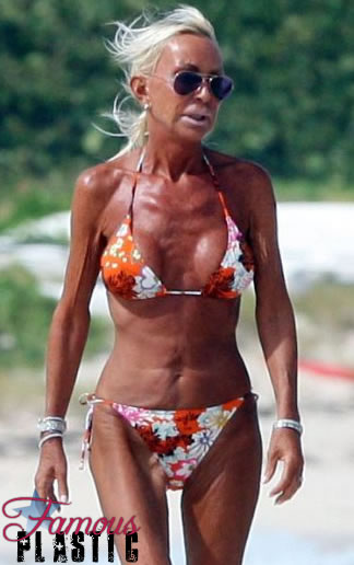 donatella versace breast implants plastic surgery