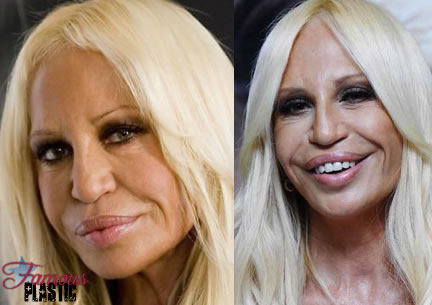 donatella versace after lip plastic surgery