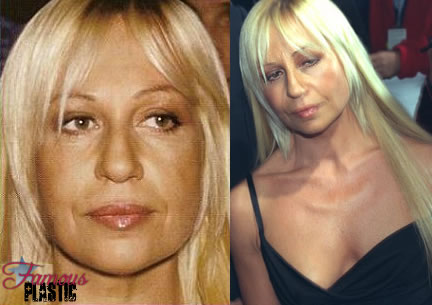 donatella versace before plastic surgery