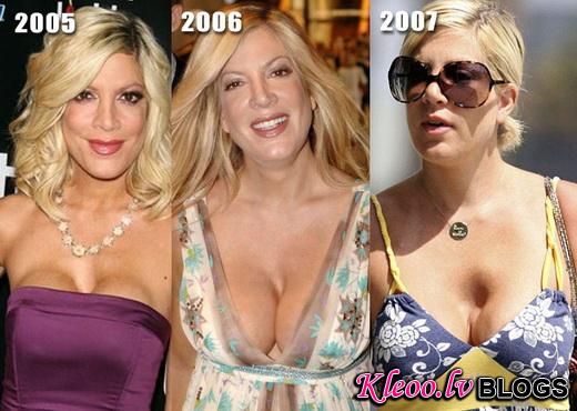 tori-spelling-breast-implants