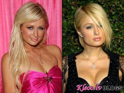 celebrities_before_and_after_plastic_surgery_03